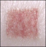 treated wound colour
