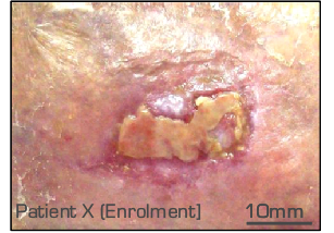 wound area measurement clinical trial