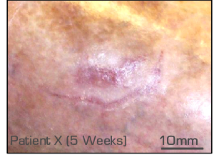 wound closure clinical trial